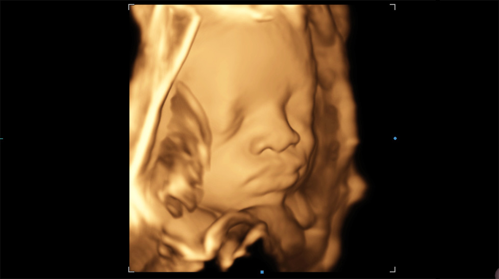 Cara fetal con 3D